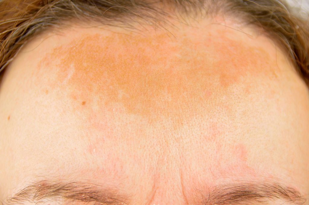 Sun-damaged skin